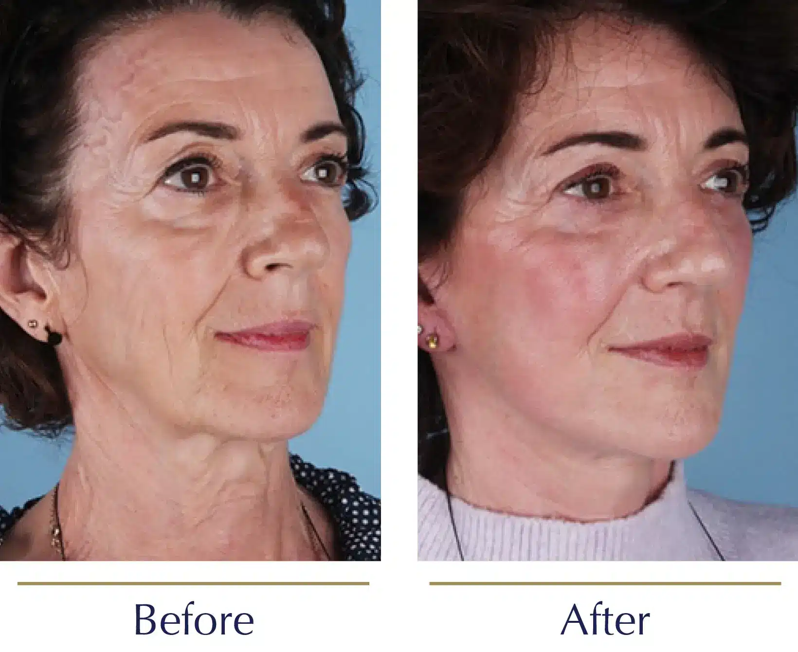 Total-Face-Refresh-Facelift-Before-and-After.webp